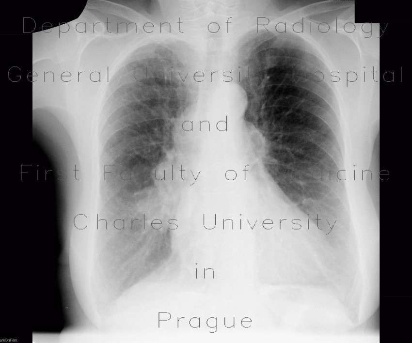 Lung tumour, adrenal metastasis, mediastinal lymphadenopathy