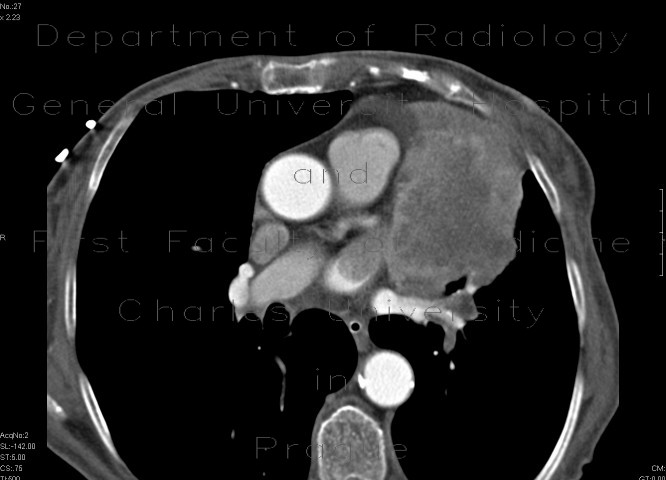 Radiology image - Lung tumour growing into the left atrium through a pulmonary vein: Thorax, Heart, Lung: CT - Computed tomography