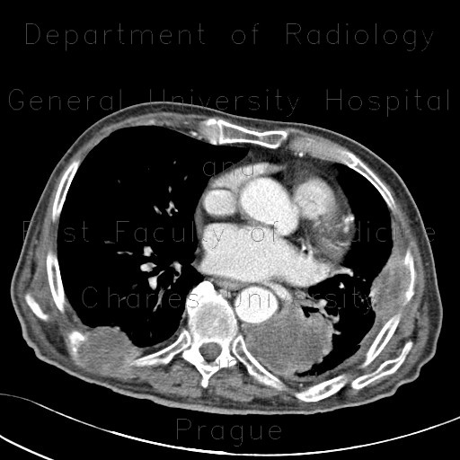 Radiology image - Lung tumour, osteolytic metastasis of ribs: Thorax, Bone, Lung: CT - Computed tomography