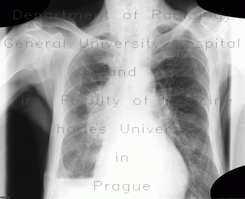 Lung tumour, pleural effusion, hydropneumothorax