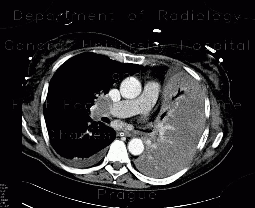 Lung tumour, tumorous infiltration of the lung wing