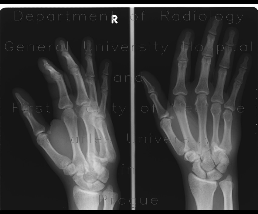 Luxation in carpometacarpal joint, initial radiograph