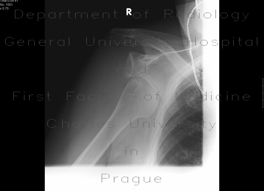 Radiology image - Luxation of the shoulder, caudal, axillary: Extremity, Bone: X-ray - Plain radiograph