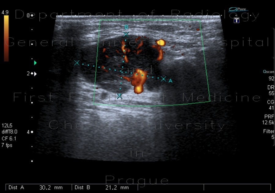 Lymph node in lymphoma