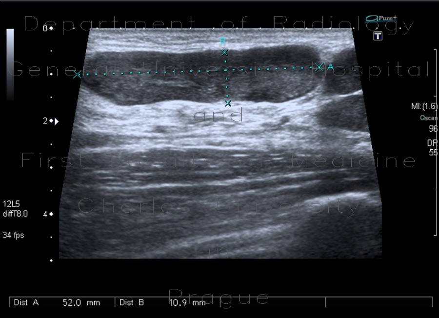 Radiology image - Lymph node, inflammatory, groin: Abdomen, Lymphatic: US - Ultrasound