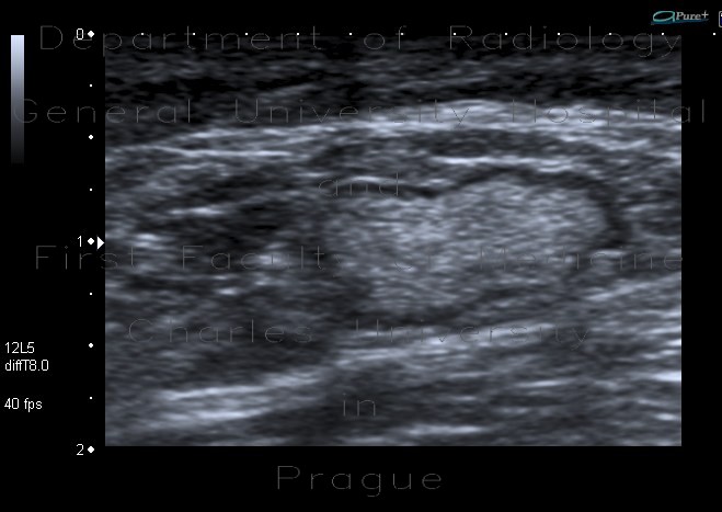 Radiology image - Lymph nodes, chronic: Abdomen, Soft tissue: US - Ultrasound