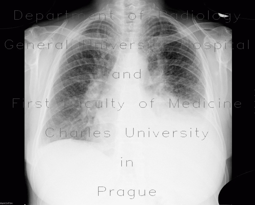 Lymphangitic carcinomatosis, fluidothorax