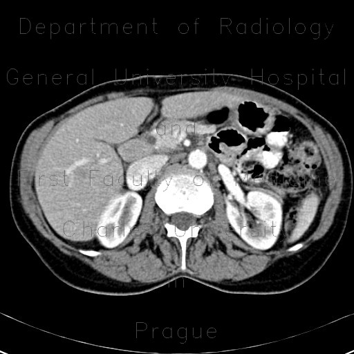 Lymphatic node, nodus foramen Winslowi, enlarged in hepatitis B and hepatitis C