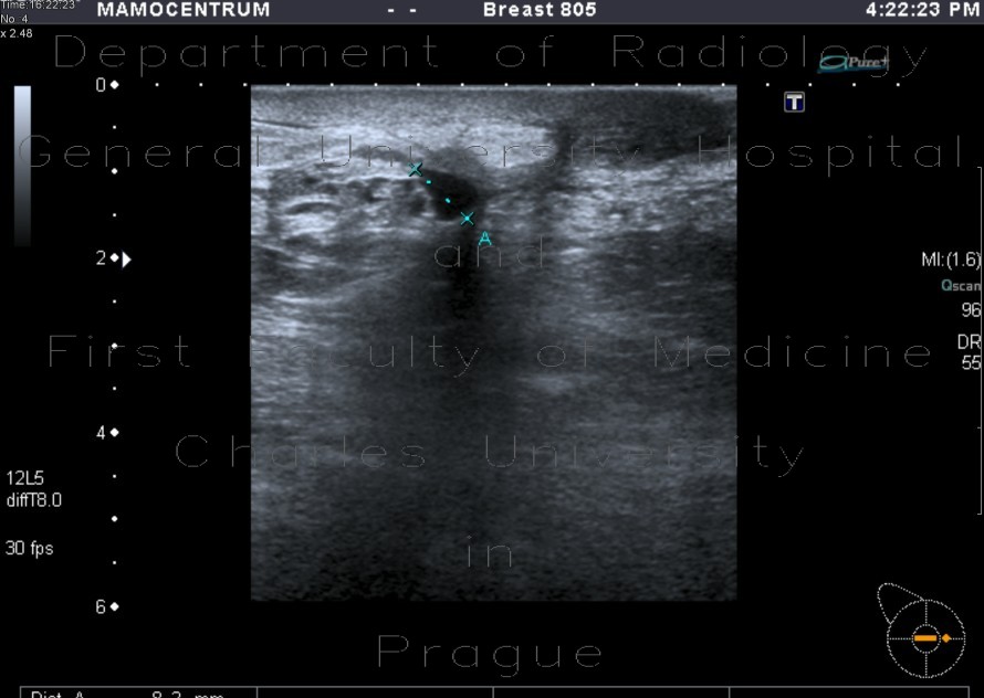 Lymphedema and seroma of the breast, postoperatively
