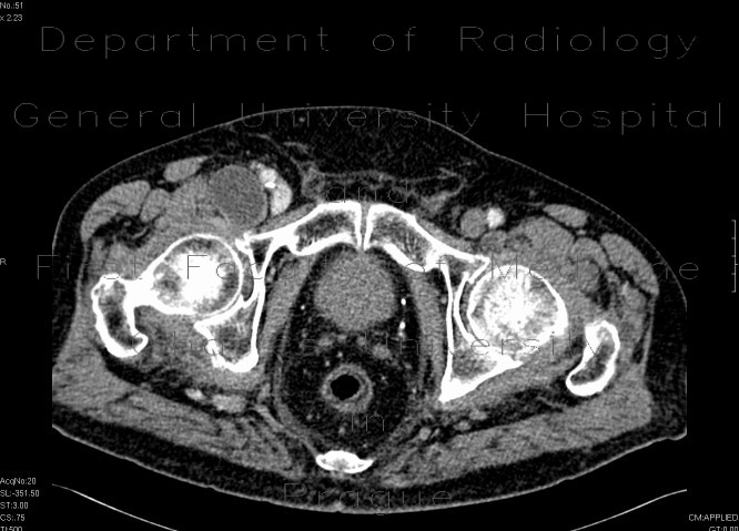 Lymphocoele