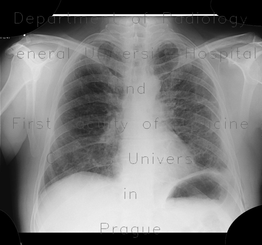 Lymphocytic interstitial pneumonia, cystic lung disease