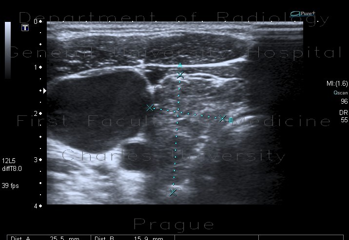 Radiology image - Lymphocytic thyroiditis: Head and Neck, Thyroid and Parathyroids: US - Ultrasound