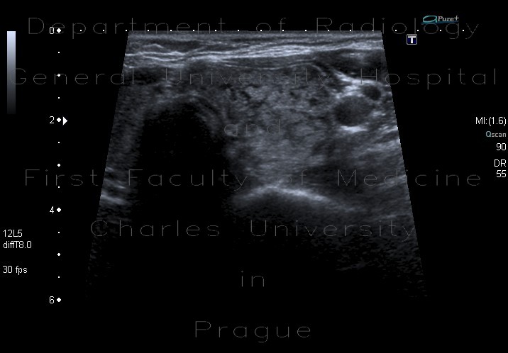 Lymphocytic thyroiditis, chronic thyreopathy