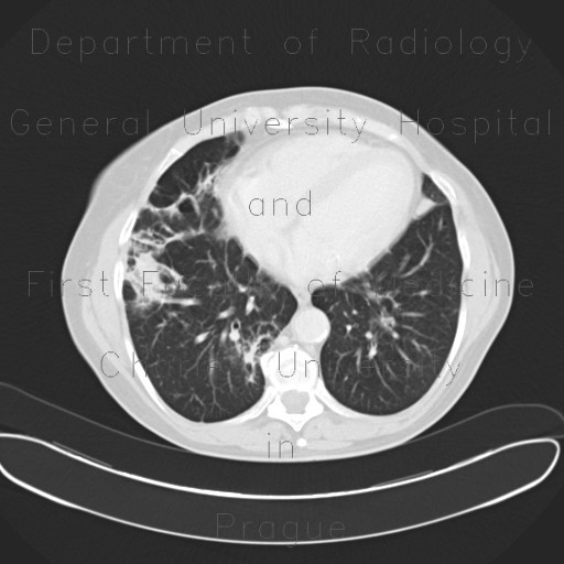 Lymphoid infiltrate in lung parenchyma