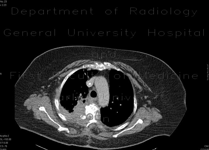 Lymphoma encroaching spinal canal