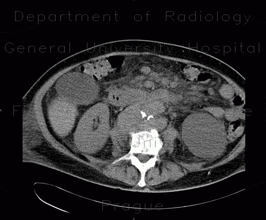 Radiology image - Lymphoma, mesenterial lymphadenopathy, edema of mesentery, correlation: Abdomen, Lymphatic, Peritoneal cavity: CT - Computed tomography