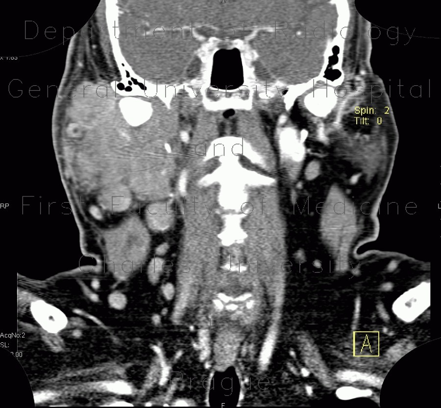 Lymphoma of parotid gland, lymphadenopathy