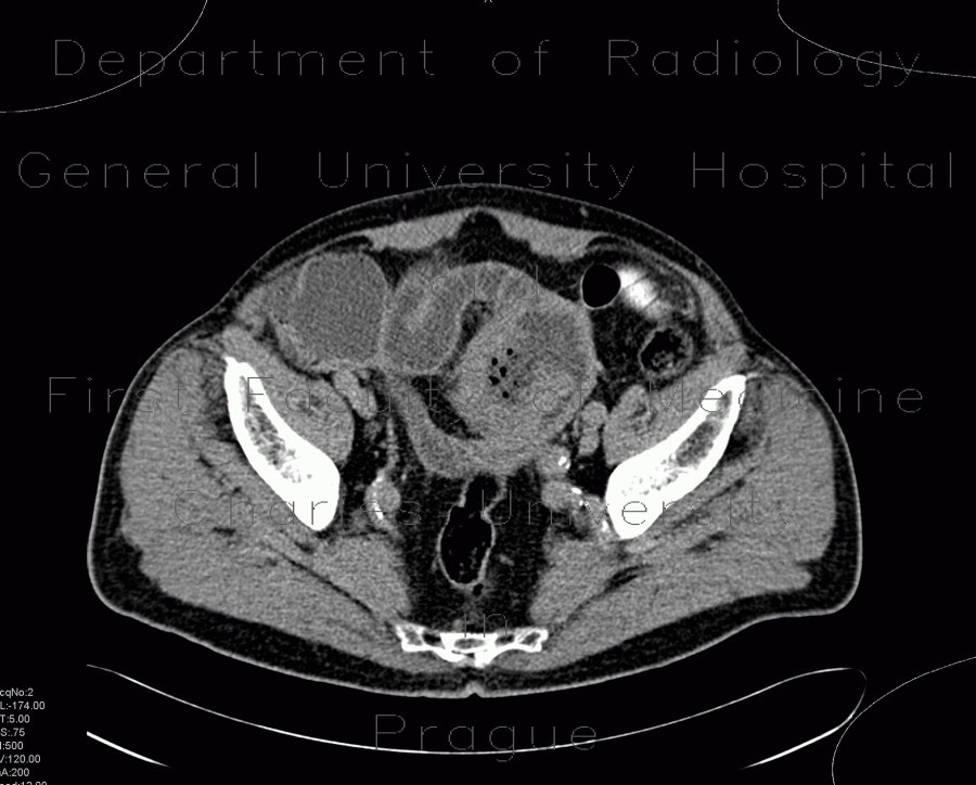 Radiology image - Lymphoma of small bowel, ileum: Abdomen, Lymphatic, Small bowel, Urinary tract: CT - Computed tomography