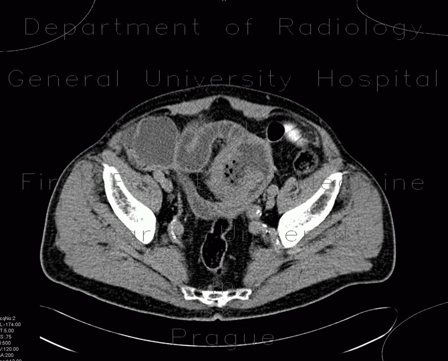 Lymphoma of small bowel, ileum