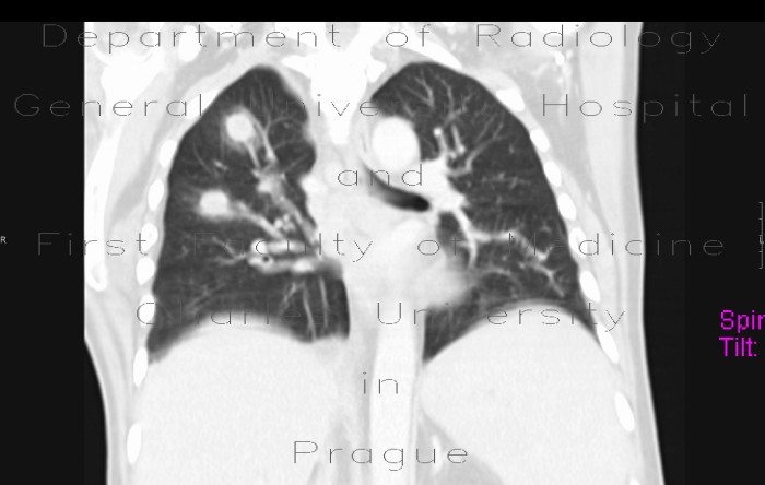 Lymphoma of the lung