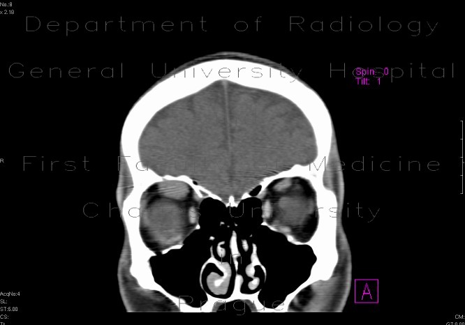 Radiology image - Lymphoma of the orbit: Head and Neck, Lymphatic, Orbit: CT - Computed tomography