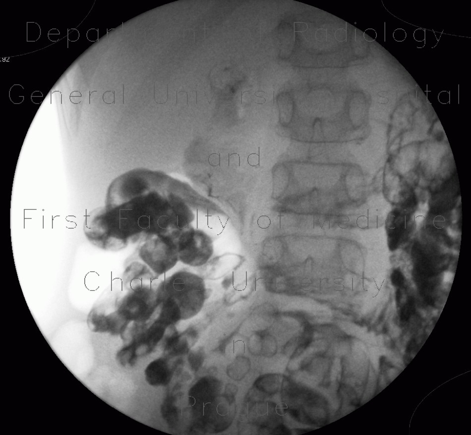 Radiology image - MNGIE, Mitochondrial neurogastrointestinal encephalopathy: Abdomen, Small bowel: RF - Fluoroscopy