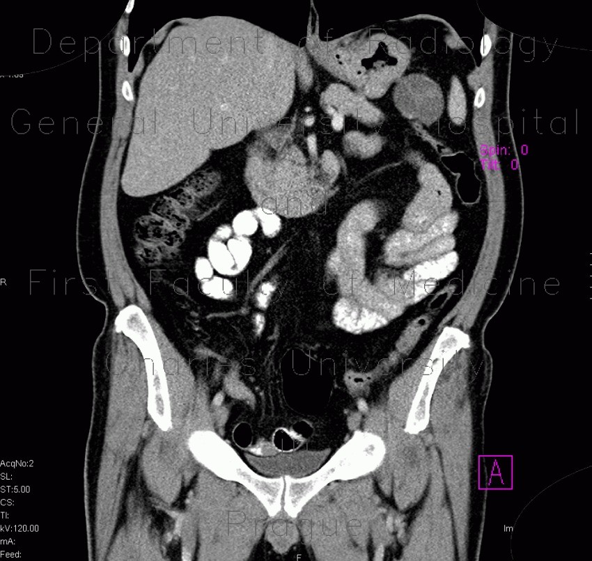 Radiology image - Macrocystic adenoma of pancreas: Abdomen, Pancreas: CT - Computed tomography