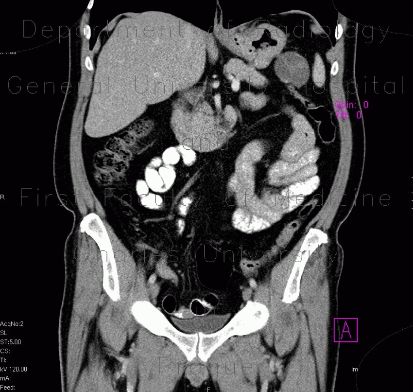 Macrocystic adenoma of pancreas