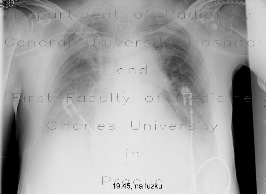 Malposition of central venous line