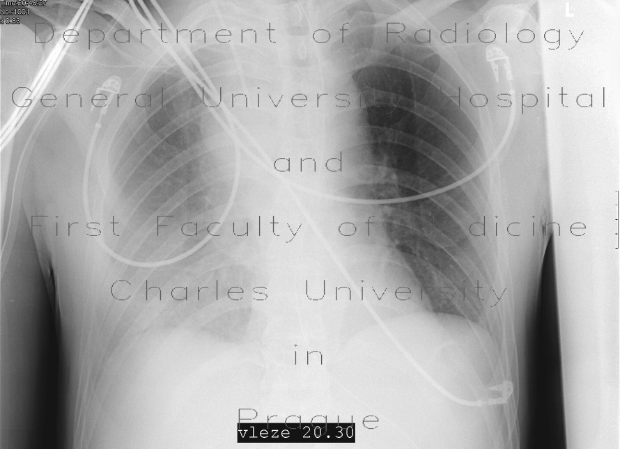 Malposition of central venous line, infusion in mediastinum