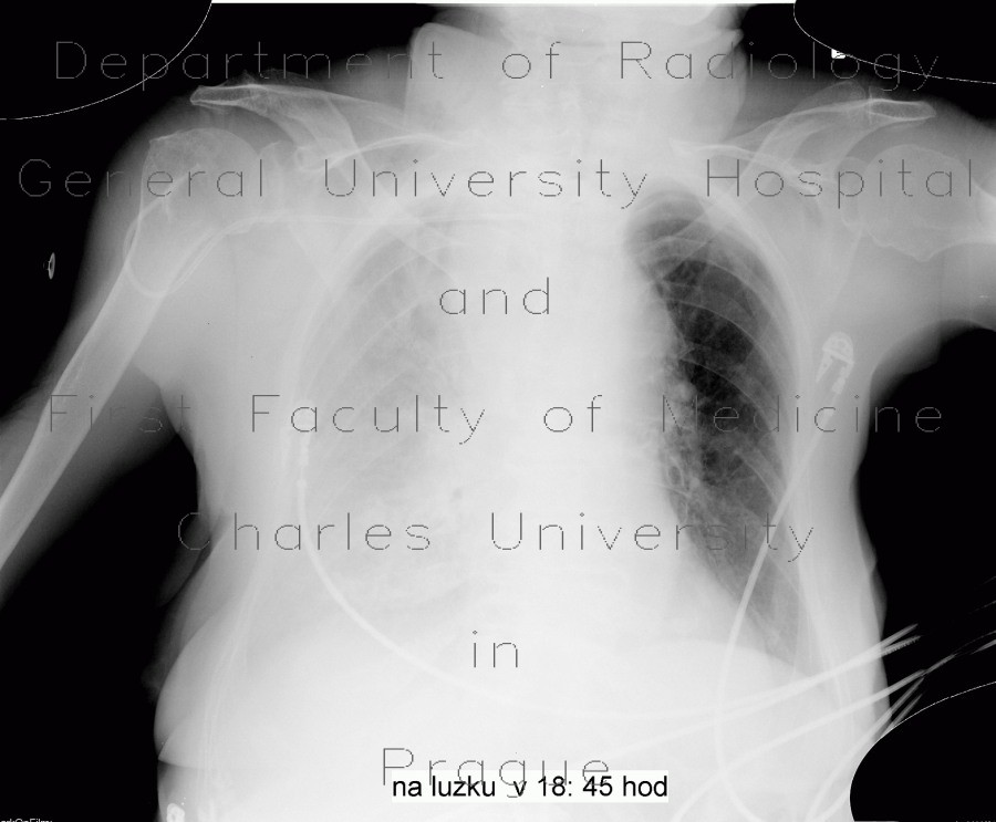 Malposition of central venous line, paravasat, fluidothorax