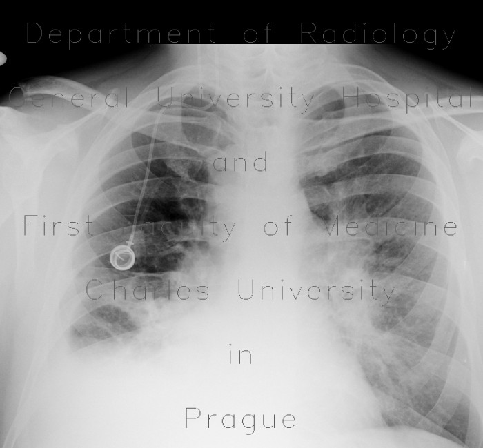 Radiology image - Malposition of portcatheter: Thorax, Mediastinum and pleural cavity, Vessels: X-ray - Plain radiograph