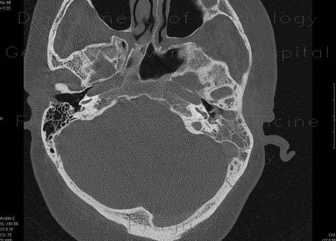 Radiology image - Mastoiditis, mesotitis: Head and Neck, Sinuses: CT - Computed tomography