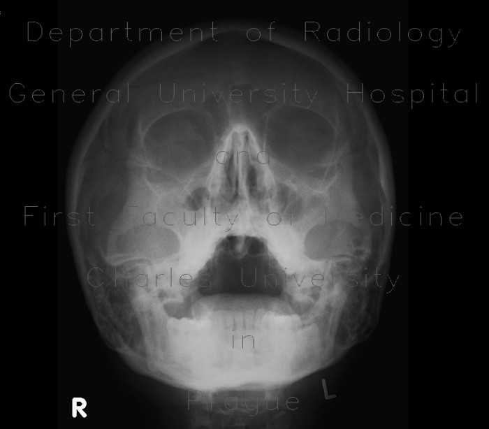 Radiology image - Maxillary sinusitis: Head and Neck, Sinuses: X-ray - Plain radiograph