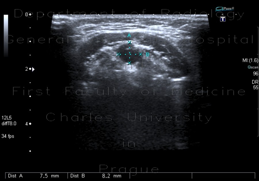 Radiology image - Medial cervical cyst: Head and Neck, Oral cavity: US - Ultrasound