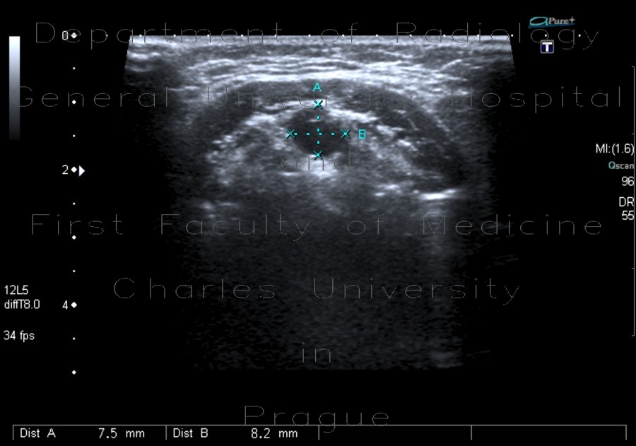 Medial cervical cyst