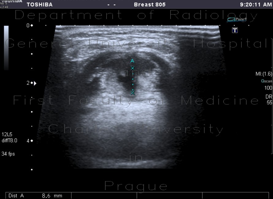 Radiology image - Median cervical cyst: Head and Neck, Oral cavity: US - Ultrasound