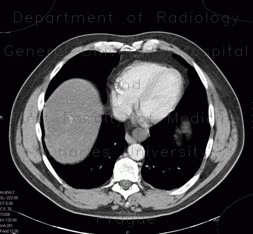 Mediastinal cyst