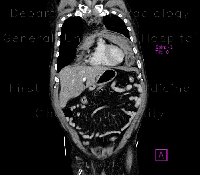 Radiology image - Mediastinal hemorrhage: Thorax, Mediastinum and pleural cavity: CT - Computed tomography