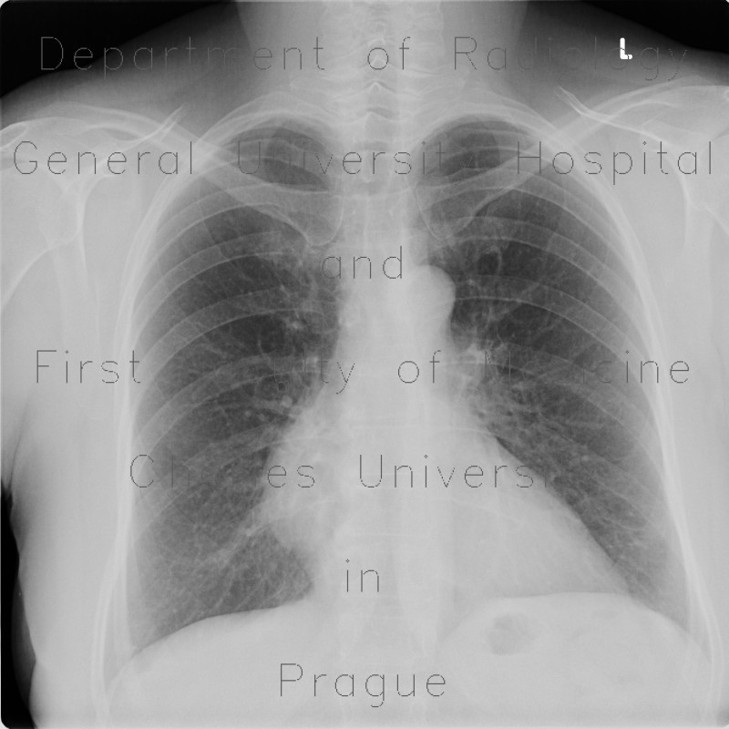 Mediastinal metastasis of malignant melanoma