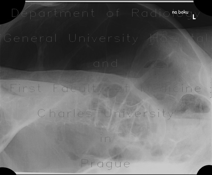 Radiology image - Megacolon, decompensated: Abdomen, Large bowel: X-ray - Plain radiograph