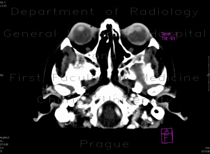 Radiology image - Melanoma, cilliary body: Head and Neck, Orbit: CT - Computed tomography