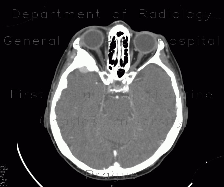 Menigioma en plaque