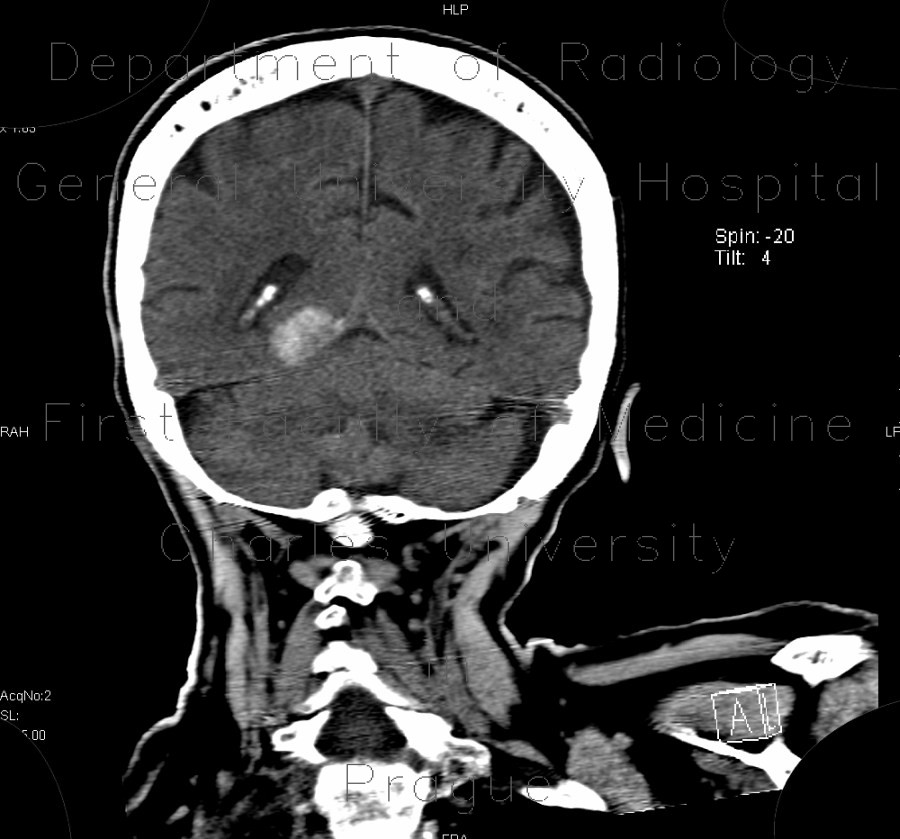Menigioma of cerebellar tentorium