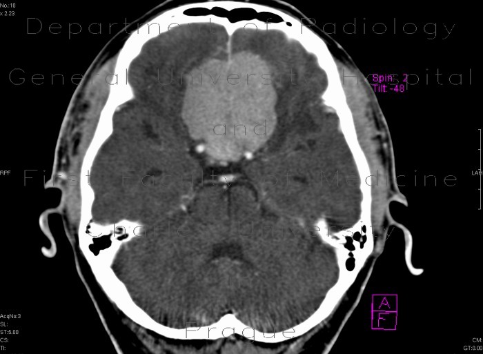 Radiology image - Meningioma of cribrous lamina: Brain, Brain: CT - Computed tomography