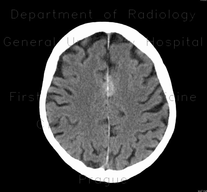 Radiology image - Meningioma of falx cerebri: Brain, Brain: CT - Computed tomography