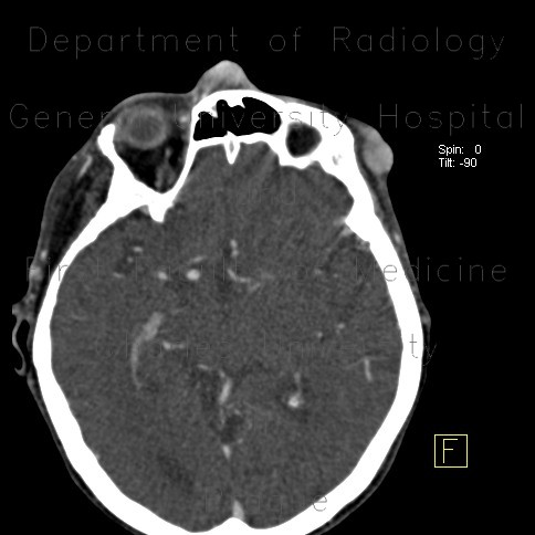 Radiology image - Merkel cell carcinoma, recurrence: Head and Neck, Soft tissue: CT - Computed tomography