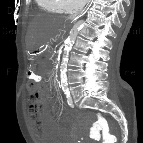 Mesenterial ischemia, gas in portal vein