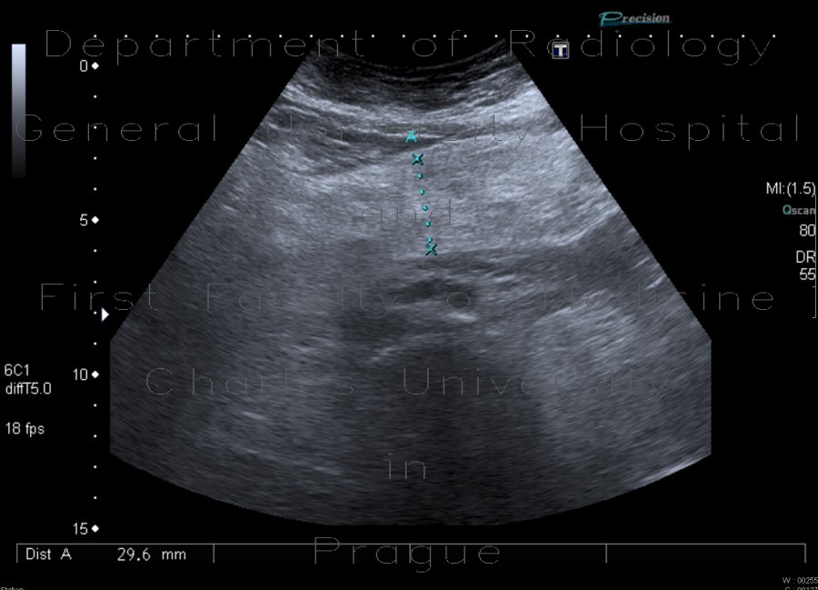 Mesenterial lipodystrophy on ultrasound