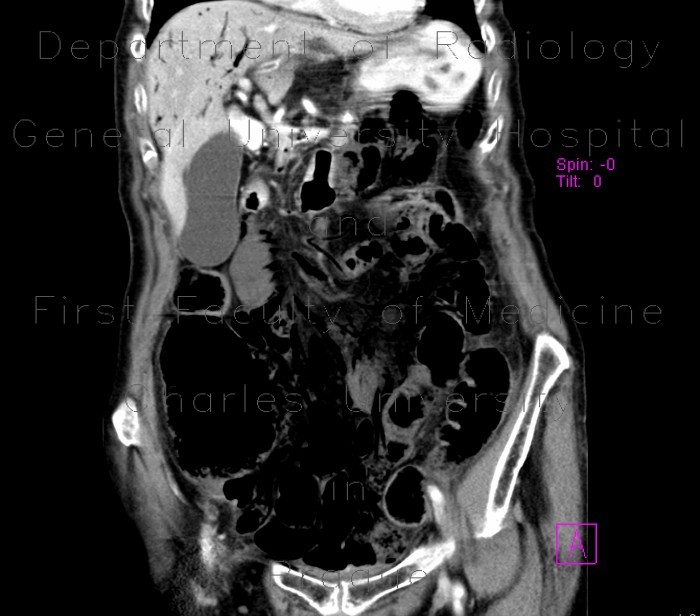 Radiology image - Mesenterial occlusion, gas in portal vein: Abdomen, Liver, Small bowel, Vessels: CT - Computed tomography